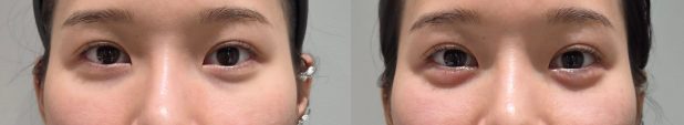 Aegyo filler — before and after at DayBeau Clinic Myeongdong