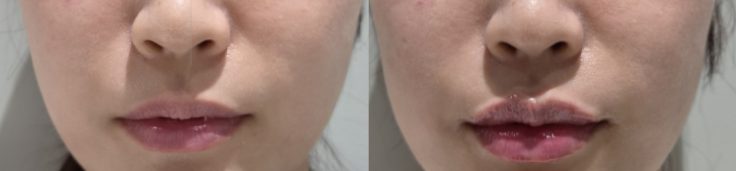 Lip filler — before and after at DayBeau Clinic Myeongdong