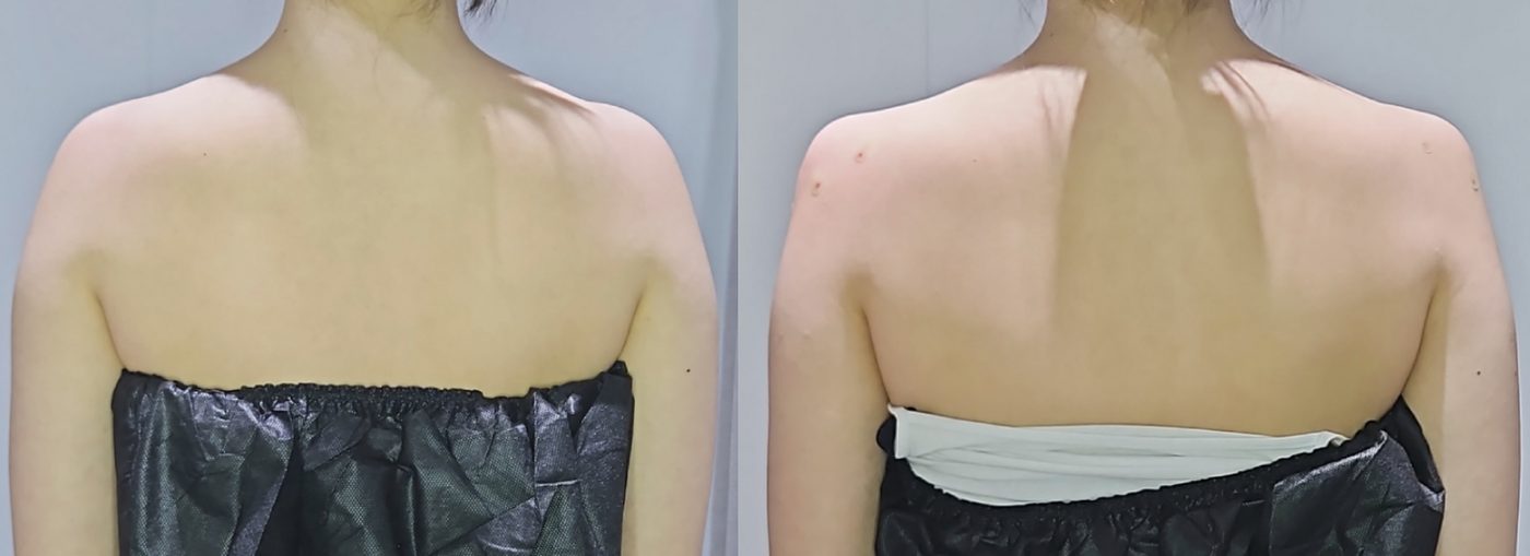 Shoulder filler — before and after at DayBeau Clinic Myeongdong
