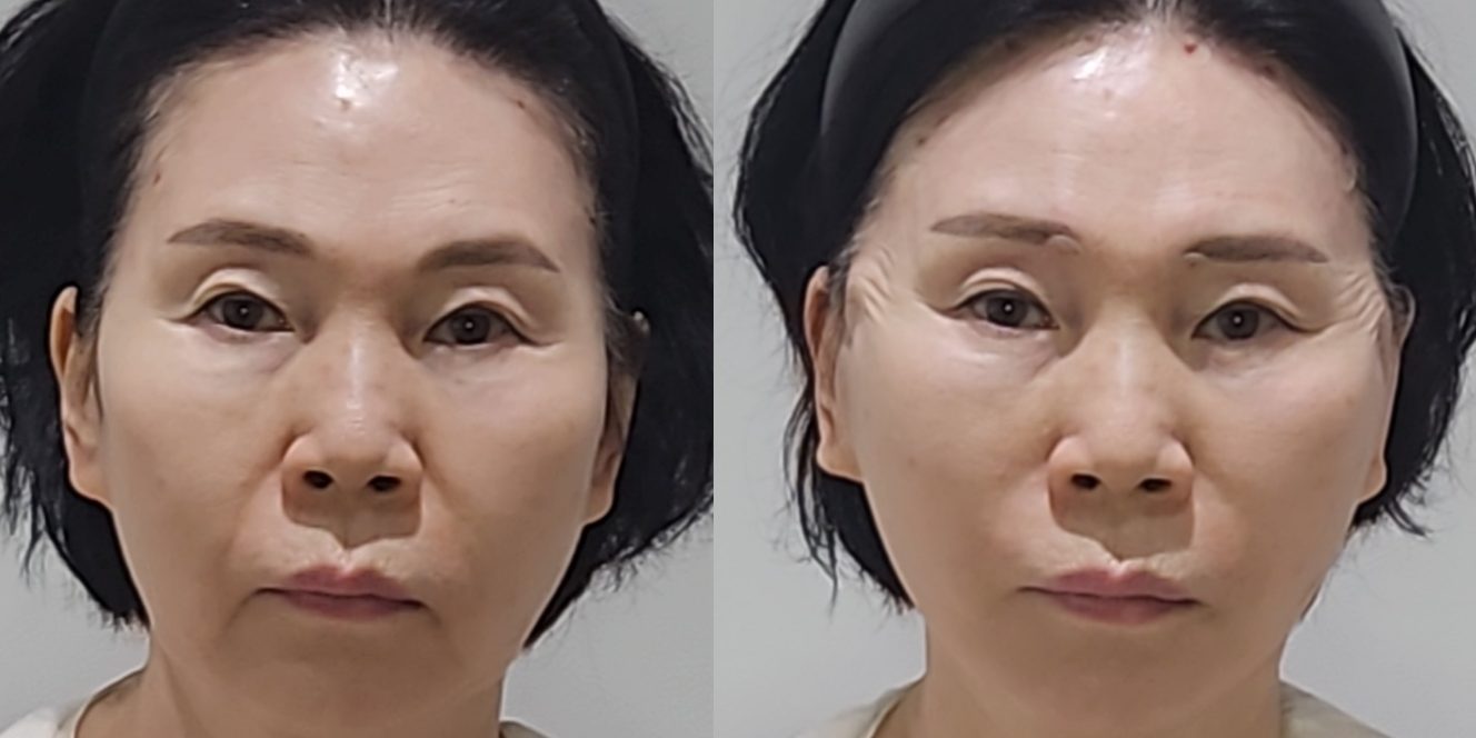 Thread lift — before and after at DayBeau Clinic Myeongdong