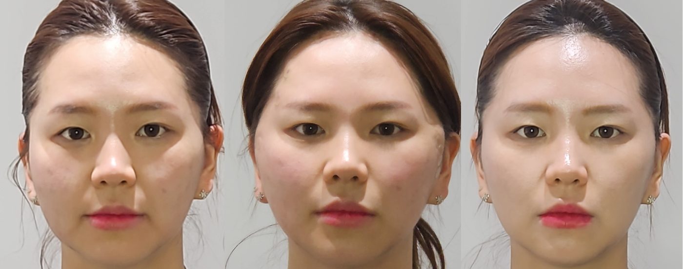 Thread lift — before and after at DayBeau Clinic Myeongdong