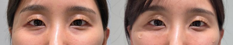 Under-eye filler — before and after at DayBeau Clinic Myeongdong