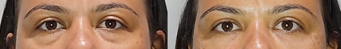 Under-eye filler — before and after at DayBeau Clinic Myeongdong